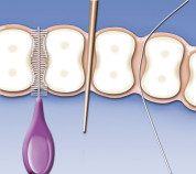 Interdentalbürsten für die Zahnzwischenräume